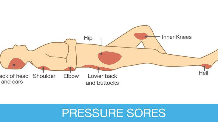 Dealing with Pressure Sores - Airospring